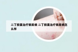 二丁膠囊治療銀屑病 二丁膠囊治療銀屑病怎么樣