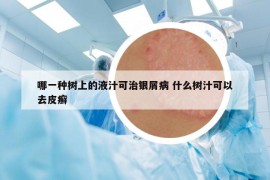 哪一種樹上的液汁可治銀屑病 什么樹汁可以去皮癬