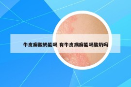 牛皮癬酸奶能喝 有牛皮病癬能喝酸奶嗎