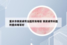 重慶市銀屑病專治醫(yī)院有哪些 銀屑病?？漆t(yī)院重慶哪家好