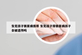 生完孩子銀屑病很厚 生完孩子得銀屑病孩子會(huì)被遺傳嗎