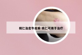 桃仁治愈牛皮癬 桃仁可用于治療