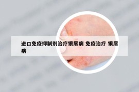 進(jìn)口免疫抑制劑治療銀屑病 免疫治療 銀屑病