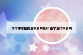 南寧哪家醫(yī)院治銀屑病最好 南寧治療銀屑病