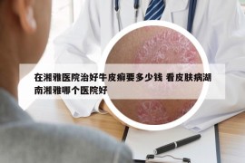 在湘雅醫(yī)院治好牛皮癬要多少錢 看皮膚病湖南湘雅哪個醫(yī)院好