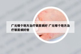 廣元哪個(gè)地方治療銀屑病好 廣元哪個(gè)地方治療銀屑病好些