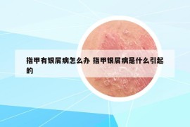 指甲有銀屑病怎么辦 指甲銀屑病是什么引起的