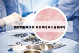銀屑病指甲頭皮 銀屑病指甲頭皮會癢嗎