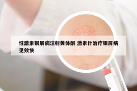 性激素銀屑病注射黃體酮 激素針治療銀屑病見效快