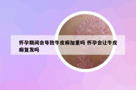 懷孕期間會(huì)導(dǎo)致牛皮癬加重嗎 懷孕會(huì)讓牛皮癬復(fù)發(fā)嗎