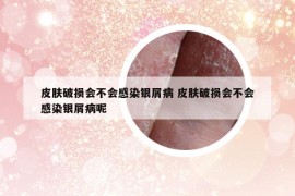 皮膚破損會不會感染銀屑病 皮膚破損會不會感染銀屑病呢
