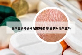濕氣重會不會引起銀屑病 銀屑病人濕氣重嗎
