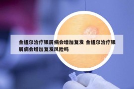 金紐爾治療銀屑病會增加復(fù)發(fā) 金紐爾治療銀屑病會增加復(fù)發(fā)風(fēng)險(xiǎn)嗎