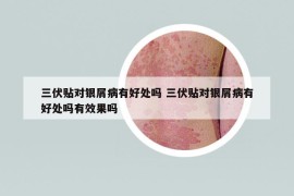 三伏貼對(duì)銀屑病有好處嗎 三伏貼對(duì)銀屑病有好處嗎有效果嗎