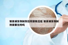 銀屑病生物制劑住院報銷流程 銀屑病生物制劑需要住院嗎