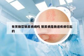 有胃腸型銀屑病病嗎 銀屑病是腸道疾病引起的