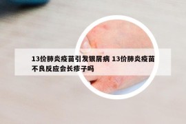 13價(jià)肺炎疫苗引發(fā)銀屑病 13價(jià)肺炎疫苗不良反應(yīng)會長疹子嗎
