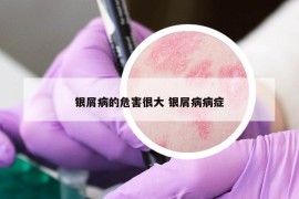 銀屑病的危害很大 銀屑病病癥