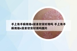 手上有手癬用維e尿素軟膏好用嗎 手上有手癬用維e尿素軟膏好用嗎圖片