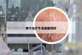 哪個(gè)治療牛皮癬醫(yī)院好