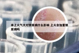 身上火氣大對(duì)銀屑病什么影響 上火會(huì)加重銀屑病嗎