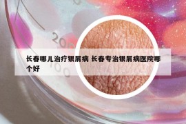 長(zhǎng)春哪兒治療銀屑病 長(zhǎng)春專(zhuān)治銀屑病醫(yī)院哪個(gè)好
