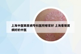 上海中醫(yī)銀屑病?？漆t(yī)院哪家好 上海看銀屑病好的中醫(yī)
