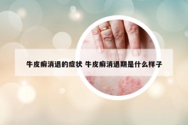 牛皮癬消退的癥狀 牛皮癬消退期是什么樣子