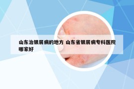 山東治銀屑病的地方 山東省銀屑病?？漆t(yī)院哪家好