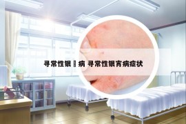 尋常性銀痟病 尋常性銀宵病癥狀