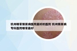 杭州哪家銀屑病醫(yī)院最好的醫(yī)院 杭州銀屑病?？漆t(yī)院哪家最好