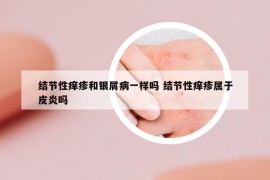 結(jié)節(jié)性癢疹和銀屑病一樣嗎 結(jié)節(jié)性癢疹屬于皮炎嗎