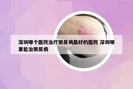 深圳哪個(gè)醫(yī)院治療銀屑病最好的醫(yī)院 深圳哪里能治銀屑病