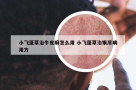 小飛蓬草治牛皮癬怎么用 小飛蓬草治銀屑病用方