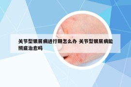 關(guān)節(jié)型銀屑病進(jìn)行期怎么辦 關(guān)節(jié)型銀屑病能徹底治愈嗎