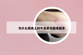 為什么我身上的牛皮癬會越來越多