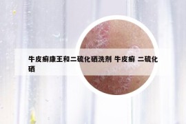 牛皮癬康王和二硫化硒洗劑 牛皮癬 二硫化硒