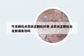 牛皮癬吃貞芪扶正顆粒好使 貞芪扶正顆粒治皮膚病有效嗎