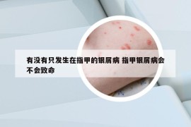 有沒有只發(fā)生在指甲的銀屑病 指甲銀屑病會不會致命
