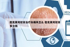 他克莫司軟膏治療白癜風(fēng)怎么 他克莫司軟膏多少錢