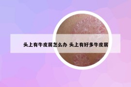 頭上有牛皮屑怎么辦 頭上有好多牛皮屑