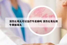 清熱化毒丸可以治療牛皮癬嗎 清熱化毒丸和牛黃解毒丸