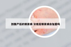 刨腹產(chǎn)后的銀屑病 分娩后銀屑病會加重嗎