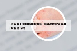 試管嬰兒能阻斷銀屑病嗎 銀屑病做試管嬰兒會(huì)有遺傳嗎