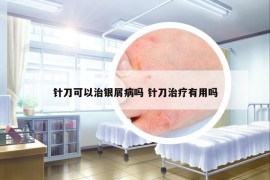 針刀可以治銀屑病嗎 針刀治療有用嗎