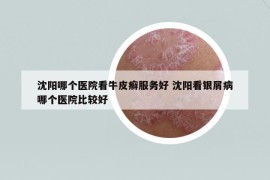 沈陽(yáng)哪個(gè)醫(yī)院看牛皮癬服務(wù)好 沈陽(yáng)看銀屑病哪個(gè)醫(yī)院比較好