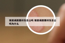 銀屑病需要終生忌口嗎 銀屑病需要終生忌口嗎為什么