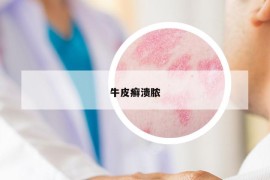 牛皮癬潰膿