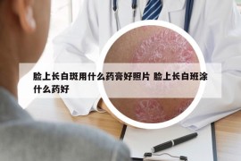 臉上長白斑用什么藥膏好照片 臉上長白班涂什么藥好
