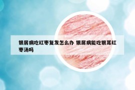銀屑病吃紅棗復(fù)發(fā)怎么辦 銀屑病能吃銀耳紅棗湯嗎